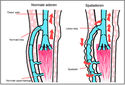 Gewone aders vs spataders